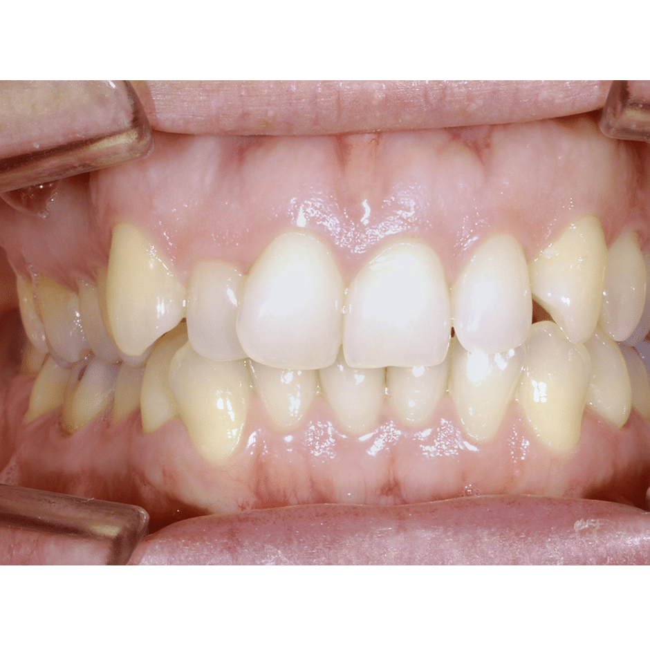 Desgaste por bruxismo