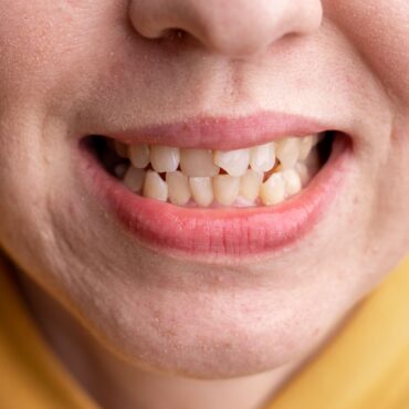 Apiñamiento Dental Y Sus Soluciones Con Ortodoncia En Palma De Mallorca clinica llibertat