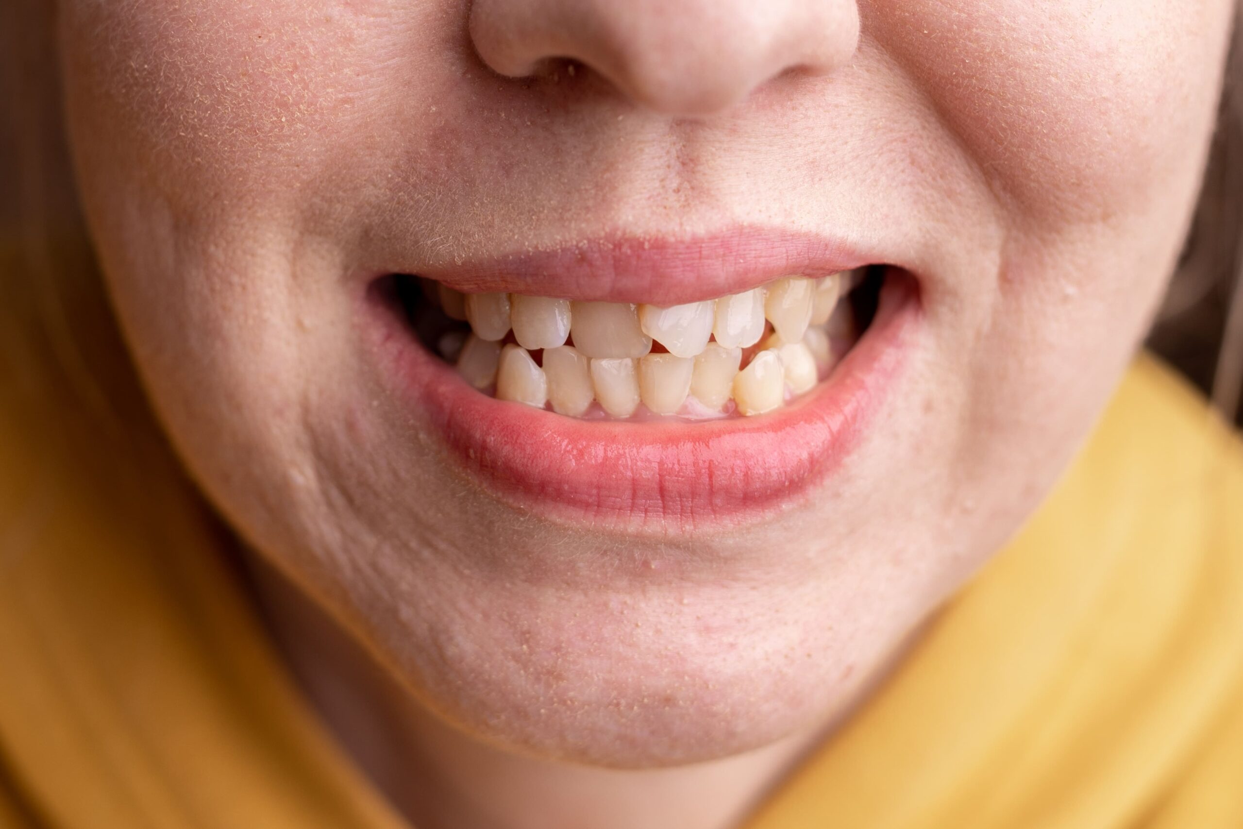 Apiñamiento Dental Y Sus Soluciones Con Ortodoncia En Palma De Mallorca clinica llibertat