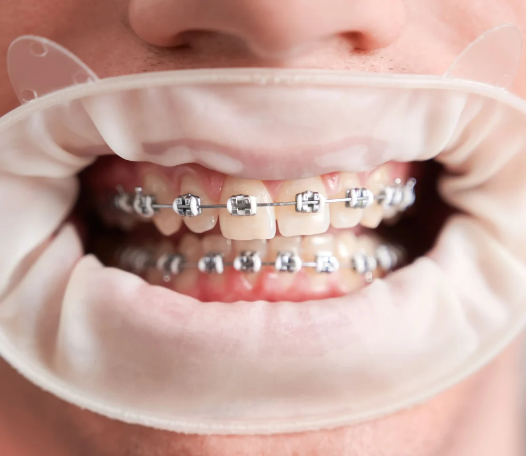 Ortodoncia Interceptiva En Palma De Mallorca clinica dental en palma de mallorca llibertat