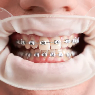 Ortodoncia Interceptiva En Palma De Mallorca clinica dental en palma de mallorca llibertat