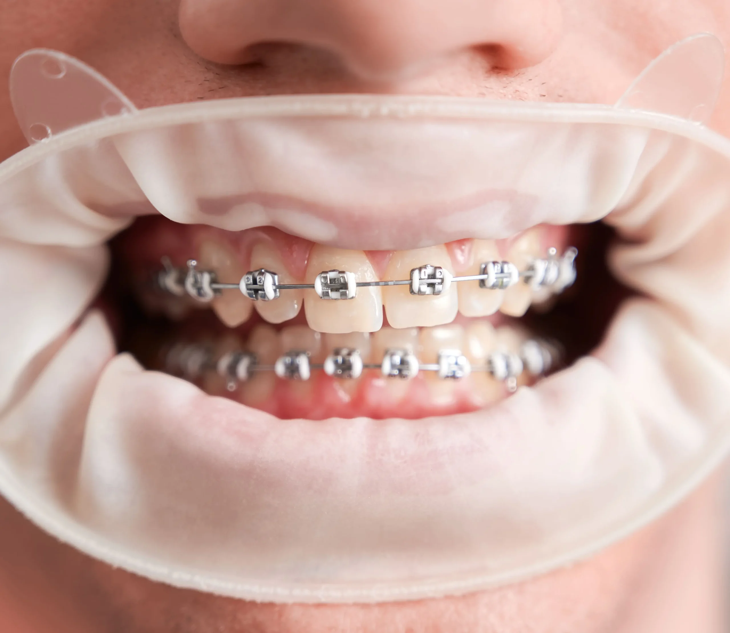 Ortodoncia Interceptiva En Palma De Mallorca clinica dental en palma de mallorca llibertat