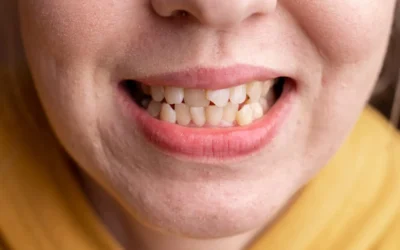 Apiñamiento dental y sus soluciones con ortodoncia