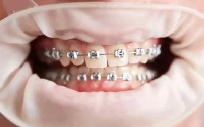 Razones para considerar la ortodoncia interceptiva