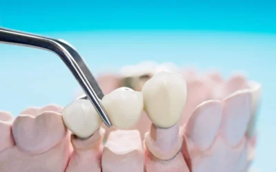 ¿Implante o un puente dental? ¿Qué es mejor?