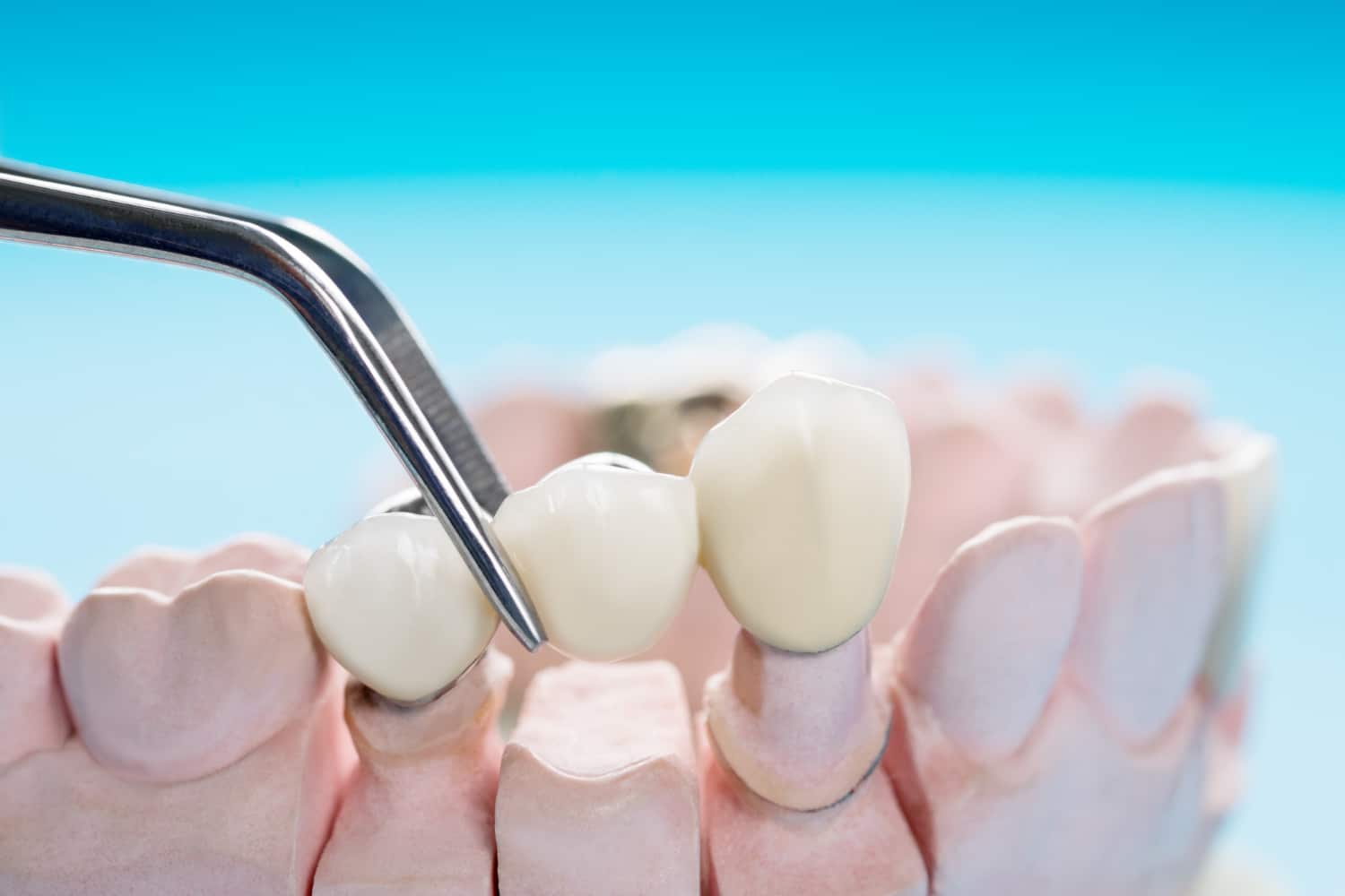 ¿Implante o puente dental? - Clínica Llibertat Palma de Mallorca