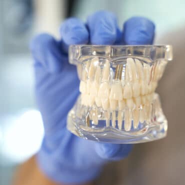 ¿Tienen los implantes dentales complicaciones a largo plazo? - Clínica Dental Llibertat Palma de Mallorca