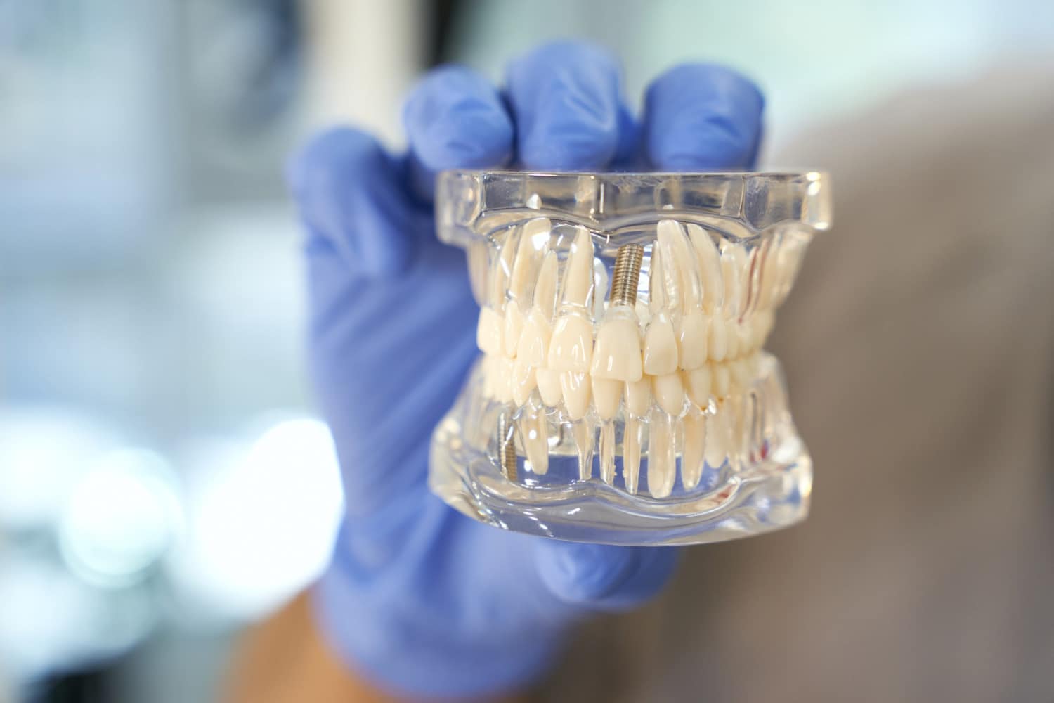 ¿Tienen los implantes dentales complicaciones a largo plazo? - Clínica Dental Llibertat Palma de Mallorca